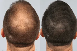 Best-prp-hair-treatment-in-hyderabad
