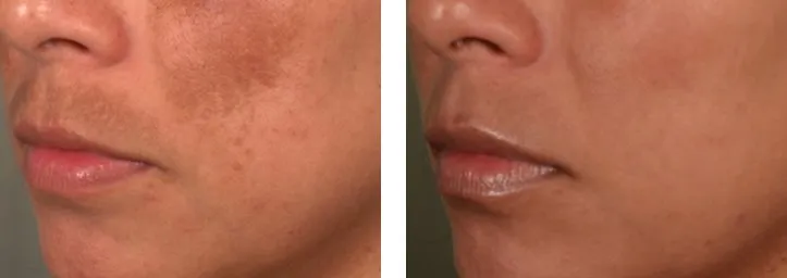 Melasma-Pigmentation-dralis